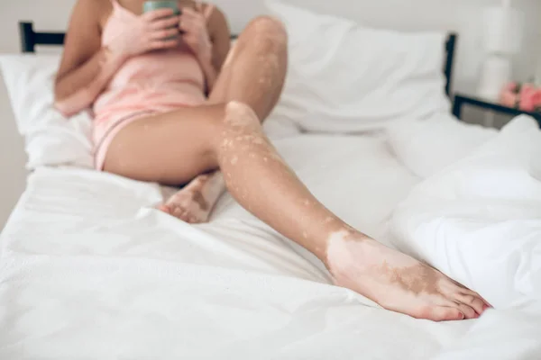 Dark-skinned woman with skin pigmentation lying in bed — Foto de Stock