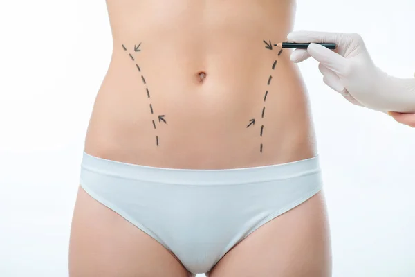 Plastic surgeon drawing lines on body of a girl — Stock Photo, Image