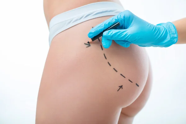 Plastic surgeon drawing lines on body of a girl — Stock Photo, Image