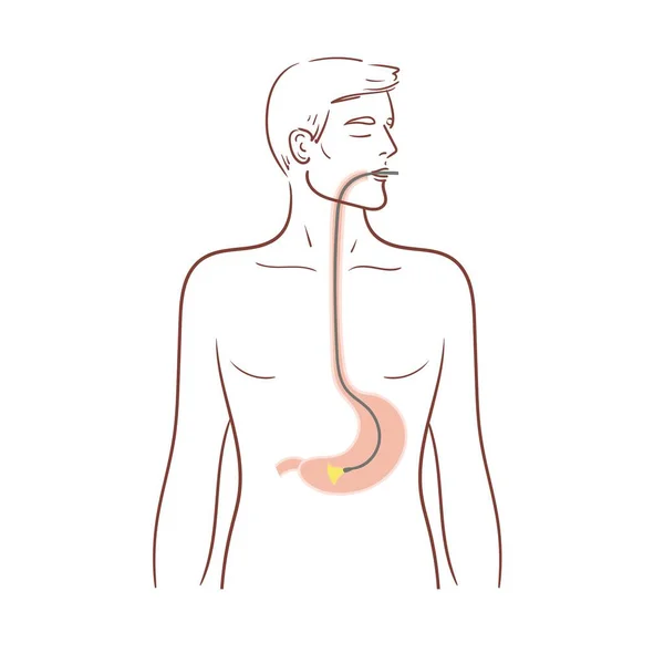 A gyomor gyomortükrözése. Nyelőcső-tükrözés, diagnosztikai eljárás.Egy férfi orvosi vizsgálaton esik át. Készletelkülönített illusztráció fehér alapon. — Stock Vector