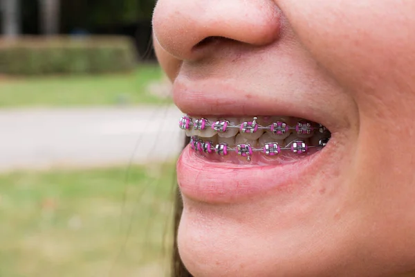 Зуби Брекетами Жіночі Зуби Відкритому Повітрі — стокове фото