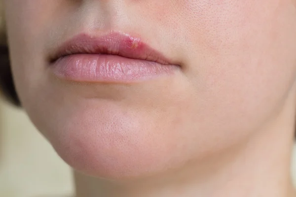 Herpès virus sur les lèvres féminines — Photo
