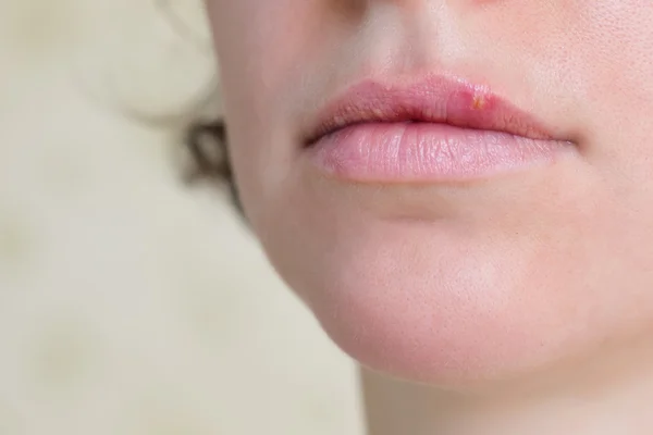 Vírus herpes nos lábios femininos — Fotografia de Stock