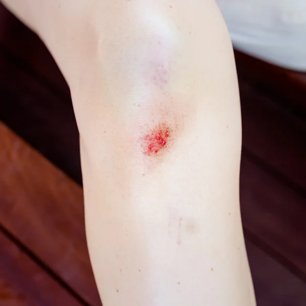女性膝盖受伤 — 图库照片