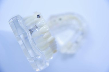 Diş hekimliği öğrencisi öğrenim modeli gösteriyor ki diş, diş eti, diş eti, diş eti hastalığı, diş çürümesi ve plaket.