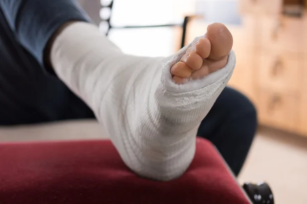 Glasvezel / gips been cas — Stockfoto