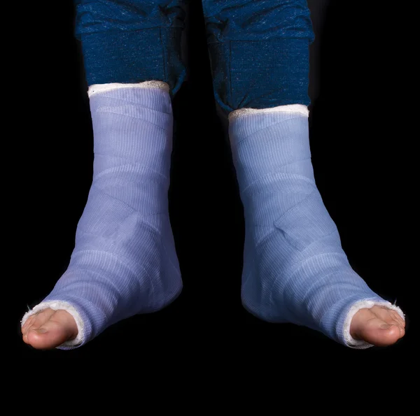 Two blue leg casts — Stock Photo, Image