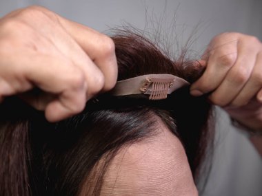 Applying a hair topper on top of a woman's natural hair and scalp. Covering hair thinning on the crown or the front area of head or adding volume. The front wig clip is visible. clipart