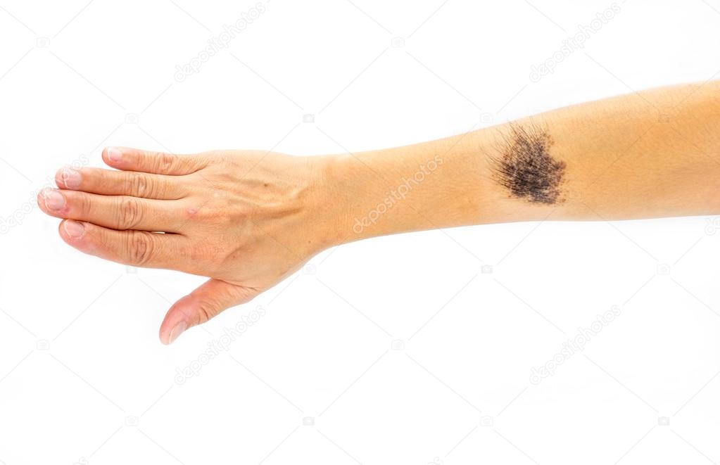 Black birthmark on arm