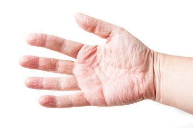 deri hastalığı. Cilt Anti yama testi üzerinde hasta gösteren kızarıklık ve şişlik arkasında. Dermatit