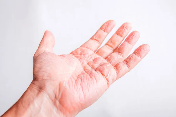 Erupción alérgica dermatitis de la pierna piel del paciente — Foto de Stock