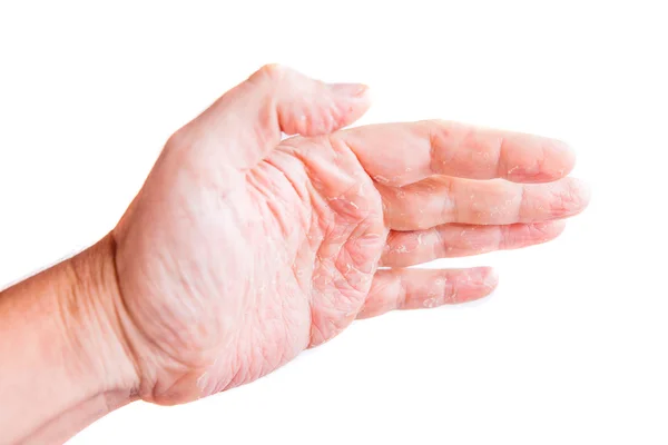 Male palms with eczema isolated on white background — Stock Photo, Image