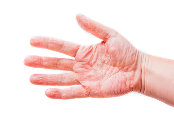 El problema con muchas personas - eczema en la mano. Fondo aislado — Foto de Stock