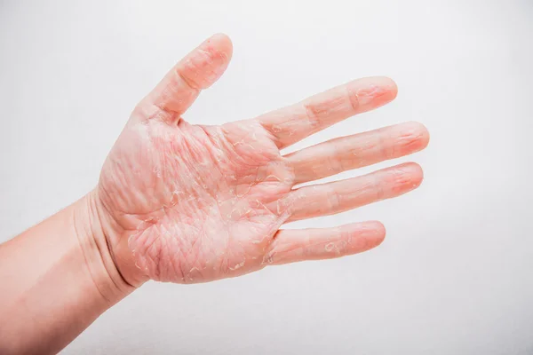 O problema com muitas pessoas - eczema na mão. Fundo isolado — Fotografia de Stock