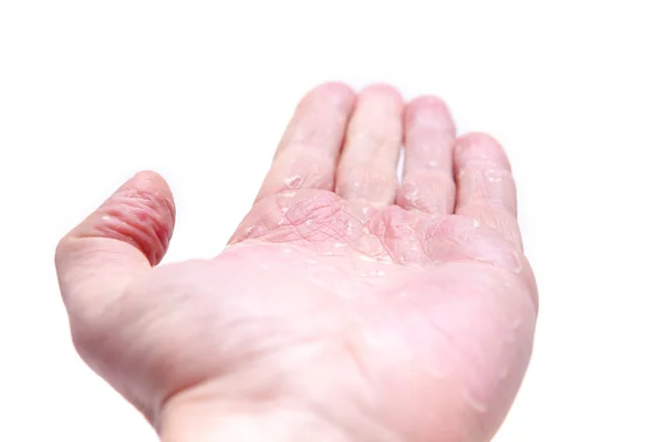 O problema com muitas pessoas - eczema na mão. Fundo isolado — Fotografia de Stock