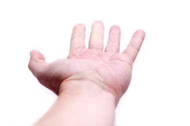 The problem with many people - eczema on hand. Isolated background clipart