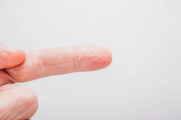 Closeup de Eczema Dermatite em Dedos Traseiros — Fotografia de Stock