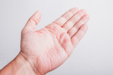Hasta Alerjik döküntü Dermatit Egzama cilt dokusunu çocuklar el at.