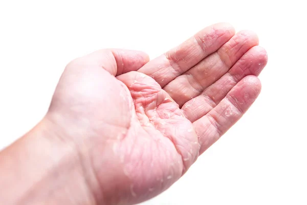 The problem with many people - eczema on hand. Isolated background — Stock Photo, Image