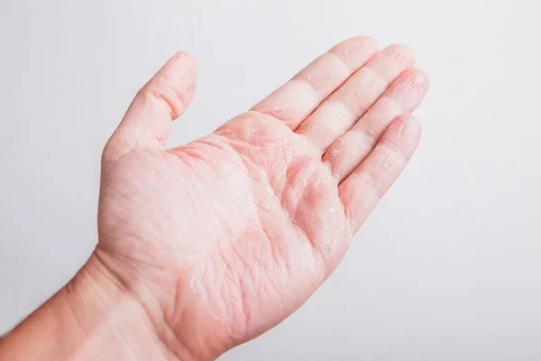 Ill allergic rash dermatitis eczema skin texture at boys hand. — Stock Photo, Image