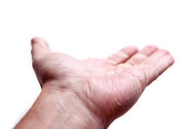 Beyaz arka plan üzerinde izole Egzama ile erkek avuç içi