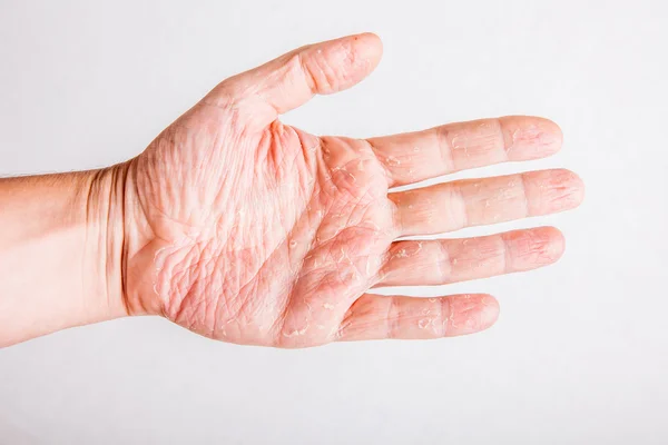 Eczema atopic dermatitis symptom skin texture — Stock Photo, Image