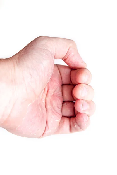 Närbild av eksem dermatit på tillbaka fingrarna — Stockfoto