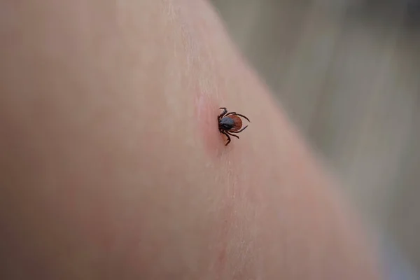 Close up of sucking female tick on human irritated skin. Bloated Ixodes ricinus dangerous parasite biting into pink irritated epidermis. Danger of Encephalitis and Lyme disease infection.