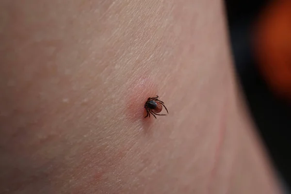 Close up of sucking female tick on human irritated skin. Bloated Ixodes ricinus dangerous parasite biting into pink irritated epidermis. Danger of Encephalitis and Lyme disease infection.