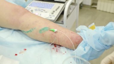 Endovasal lazer pıhtılaşması. Cerrah varis damarlarını çıkarıyor.