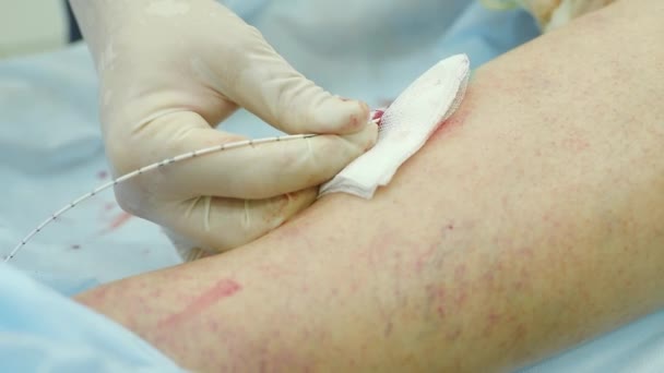 Endovasal laser coagulation-the surgeon removes varicose veins — Stock Video