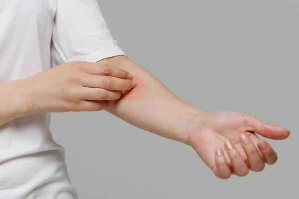 Primer Plano Mujer Rasguñándose Picazón Mano Aislada Sobre Fondo Gris — Foto de Stock