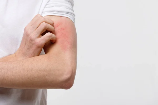 Close Male Scratching Itch His Hand Isolated Grey Background Copy — Stock Photo, Image