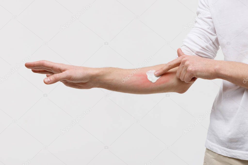 Bouts of allergies concept. Allergic reaction, itch, dermatitis, dry skin. Man is applying cream/ointment on the swell skin against mosquito bites, isolated on white background, close up. 