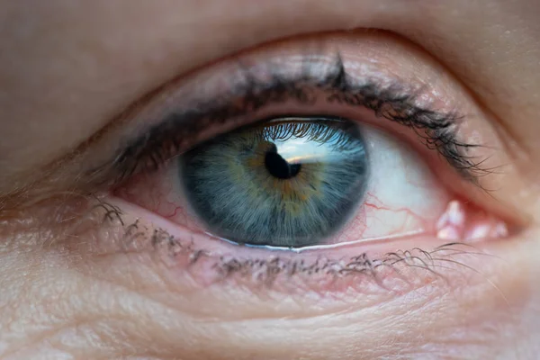 Girl with irritated dry red eye or allergy. Female suffering from redness. — Stock Photo, Image