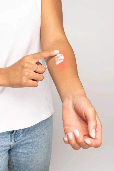 Hembra aplicando crema sobre la piel hinchada después de picaduras de insectos, aislada sobre fondo gris de estudio. Alergia. — Foto de Stock