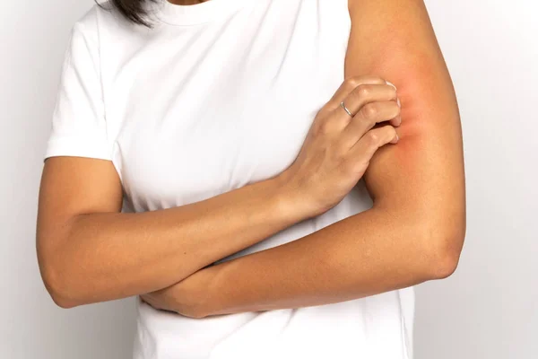 Meisje krabben jeuk aan de hand, last van droge huid of pruritus, dierlijke allergie, insectenbeten. Studio — Stockfoto