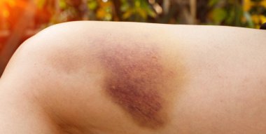 Hematom ve Büyük Çürük, deri altında kan toplanması, yaşlı bir adamın yürürken tökezlemesi ve yere düşmesi. Yara ve acı. Boşluğu kopyala