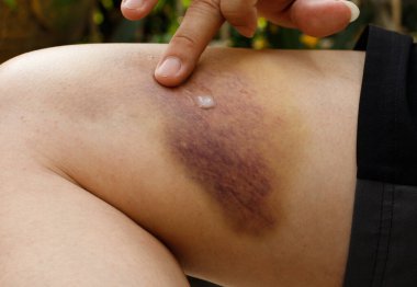 Hematom ve Büyük Çürük, deri altında kan toplanması, yaşlı bir adamın tökezlemesi ve yere düşmesi. Hemşire yaşlıları iyileştirmek için ağrı kesici sürmüş.