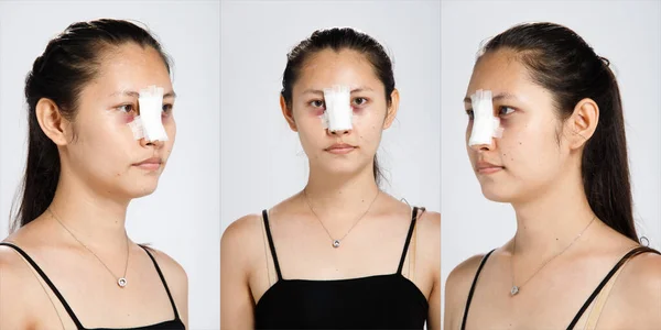 Asian woman did Nose plastic surgery to lift up shape. After Rhinoplasty, patient needs bandage on nose face for two weeks.