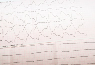 EKG teyp paroksismal Ventriküler Taşikardi ve Ventriküler kalp kası yetmezliği ile