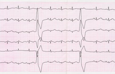 EKG ile Ventriküler Prematüre beats (quadrigeminia bant)