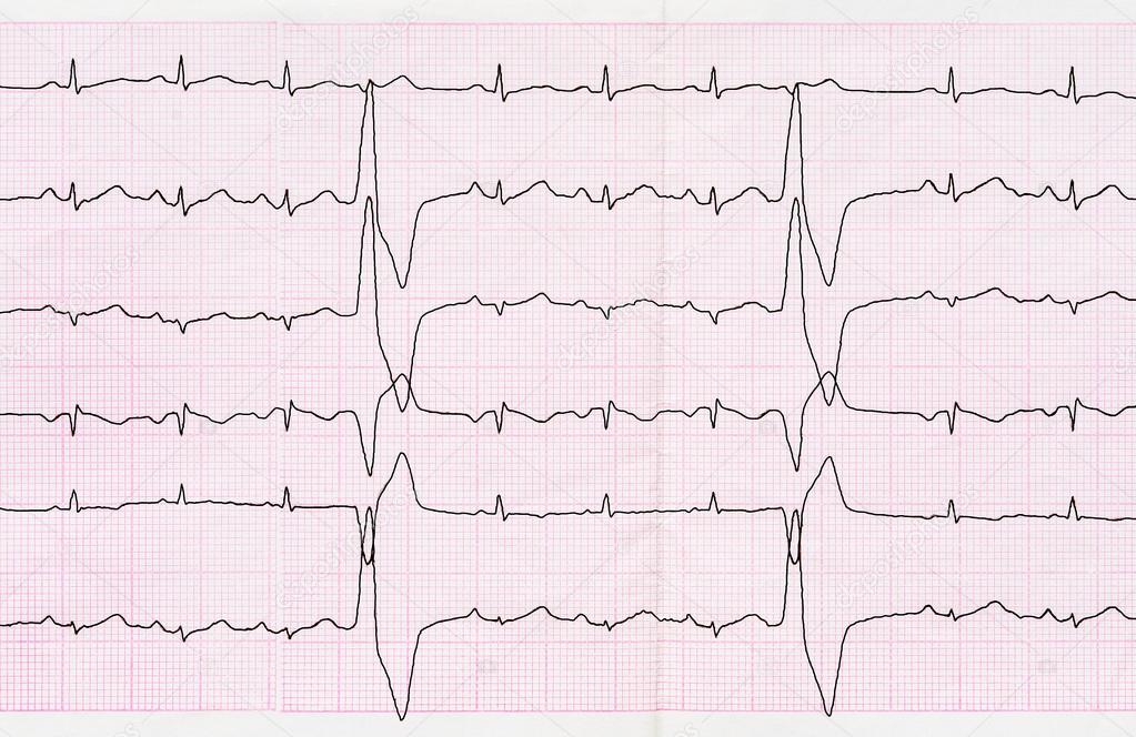 Tape ECG with ventricular premature beats (quadrigeminia) Stock Photo ...