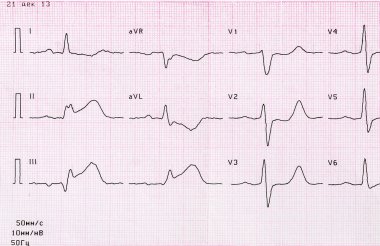 Akut miyokard infarktüsü noktayla EKG teyp  