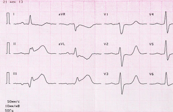 Akut miyokard infarktüsü noktayla EKG teyp  