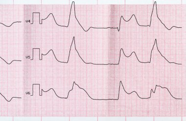 Teyp EKG macrofocal Miyokard İnfarktüsü ve Ventriküler bigemia