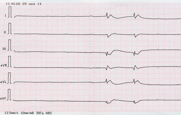 EKG páska ("umírající srdce") — Stock fotografie