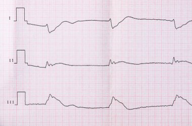 Teyp EKG sonra klinik ölüm ve başarılı resüsitasyon