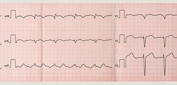 Tape ECG with paroxysm of atrial flutter — Stock Photo, Image