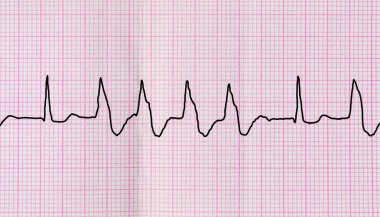 Teyp EKG ile grup Ventriküler extrasystoles